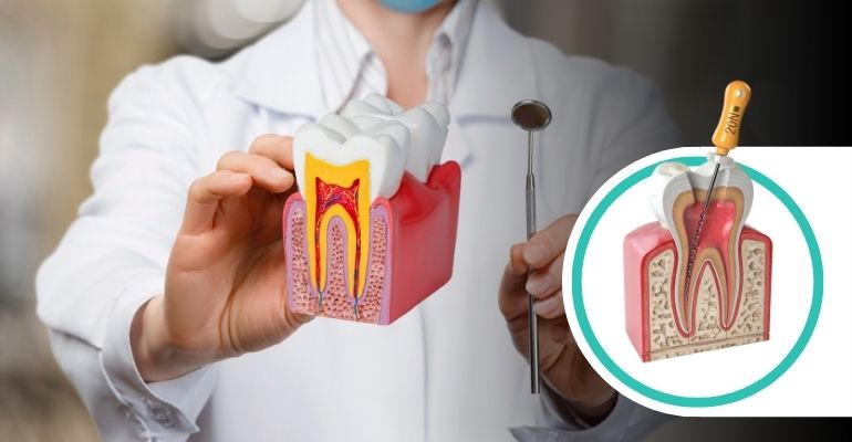 root-canal-treatment
