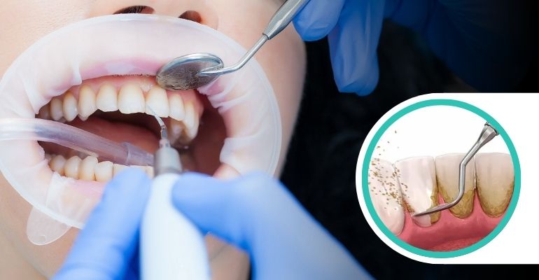 teeth-cleaning