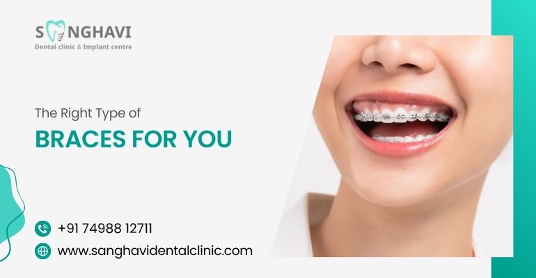 The Right Type of Braces for You